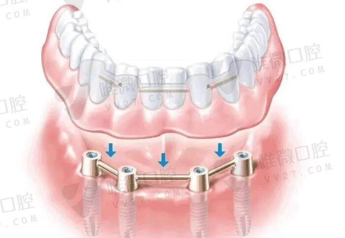 种植牙为何需要做上颌窦提升手术的原因