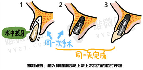 即刻种植的治疗周期更短