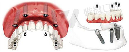 即刻种植更适合半口或全口缺牙修复
