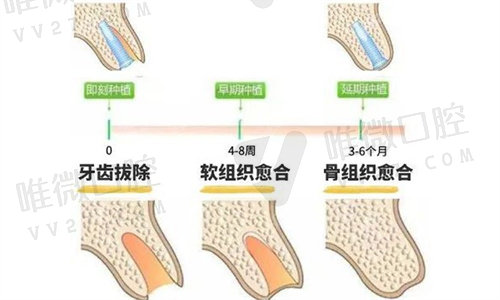 即刻种植和传统种植哪个<span style=