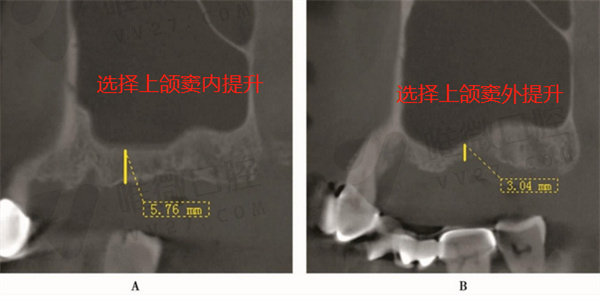 种牙上颌窦提升全过程