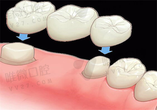 北京科尔口腔医院种植牙价格