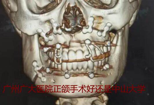 广州广大医院正颌手术好还是中山大学附属口腔医院