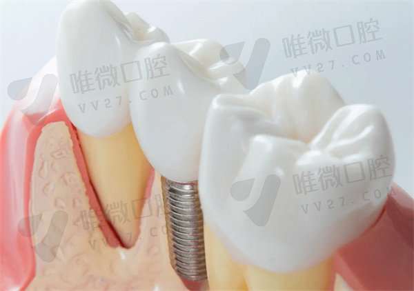 韩国种植牙品牌及价格