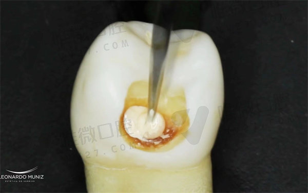补牙时牙医故意将牙齿钻漏了怎么办