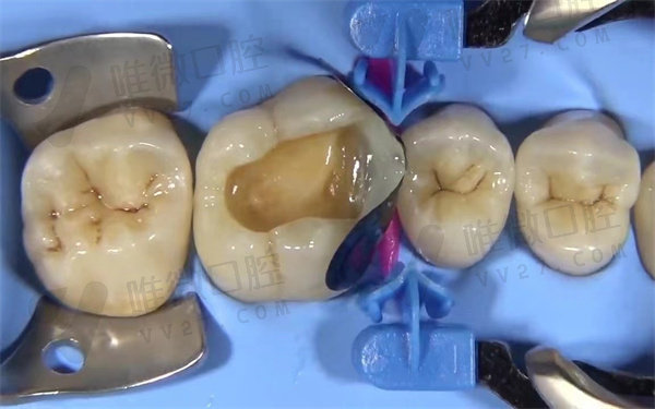 补牙时牙医故意将牙齿钻漏了怎么办