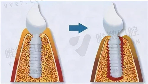 种植牙可能引发牙颌骨吸收