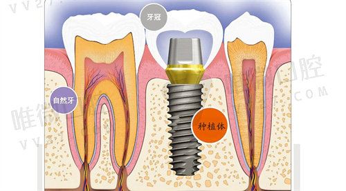 深圳市口腔医院种植牙价格表2023年