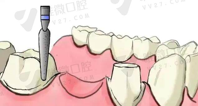 纯钛种植牙的优缺点