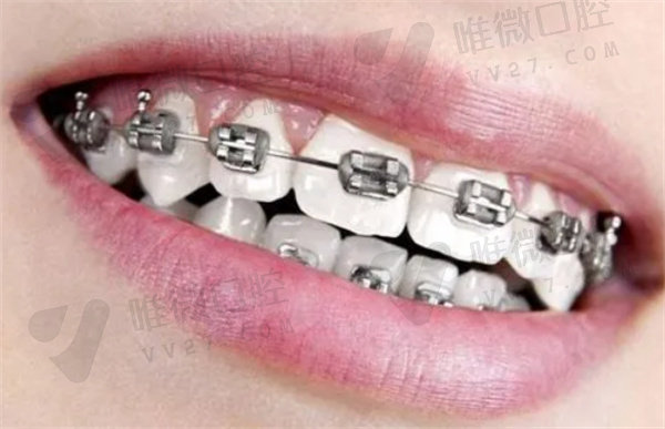 虎牙长在牙龈上怎么矫正