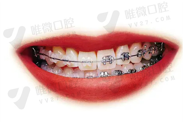 虎牙长在牙龈上怎么矫正