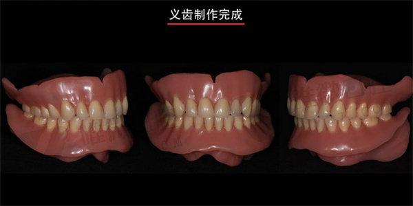 普通全口义齿和吸附性义齿区别在哪