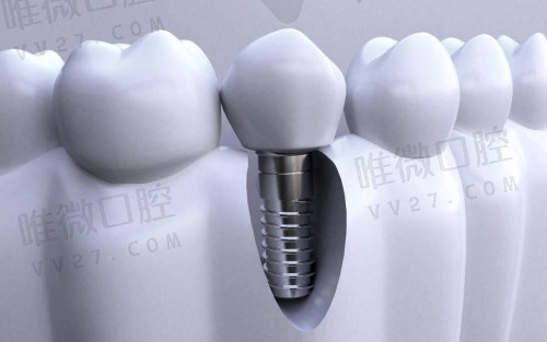 牙齿修复缺失有几种方法