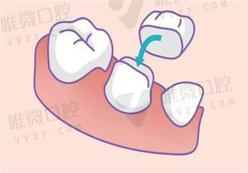 再生细胞种植牙未来可以代替种植牙吗