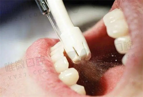洗牙能把黄牙洗白吗