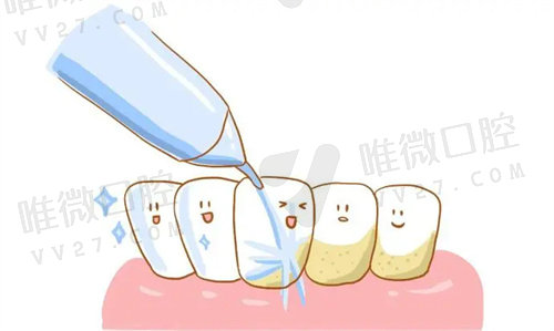 洗牙对牙齿的利弊有什么