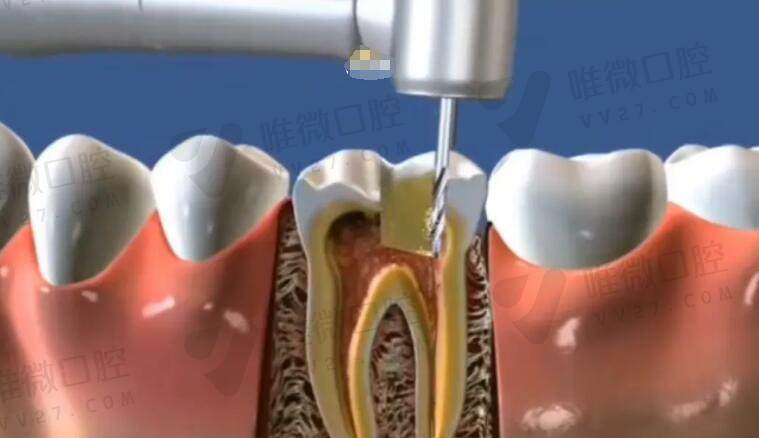 根管治疗是什么意思？