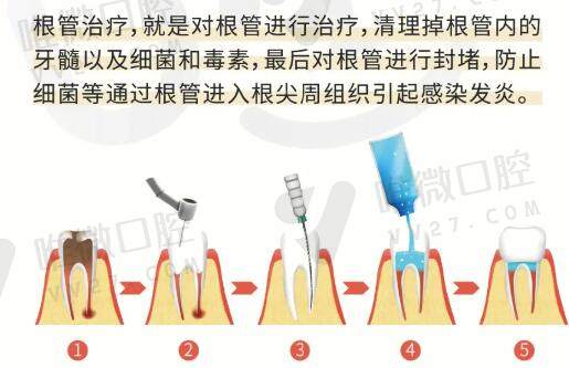 根管治疗的治疗步骤及原理