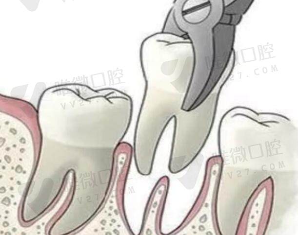 根管治疗6年后又发炎了，是要二次根管治疗好还是拔了好？