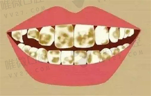 冷光美白对牙齿有什么伤害