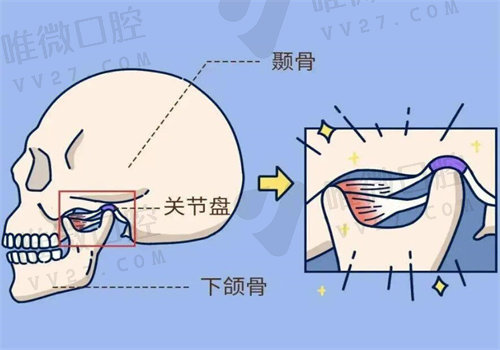 颞下颌关节紊乱是什么