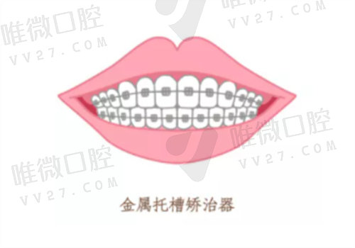 广州德伦口腔牙齿矫正多少钱