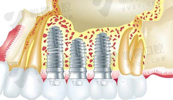 种植牙缺点