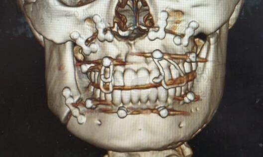 骨性凸嘴必须做正颌手术吗？