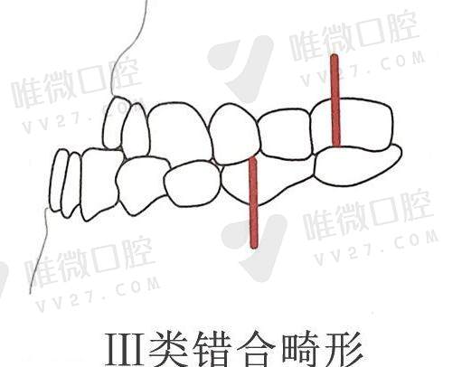 地包天矫正后悔一辈子