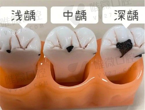 树脂补牙能维持多久