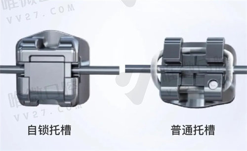 普通托槽和自锁托槽区别图片