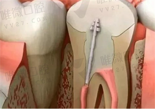 做完根管治疗后需要注意什么