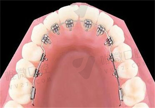 四川省人民医院口腔科牙齿矫正收费标准