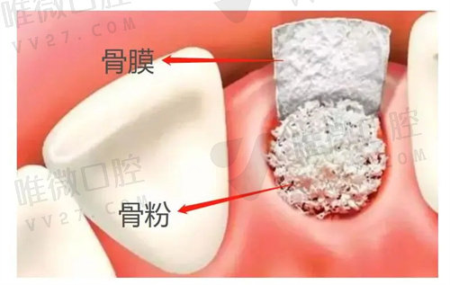 牙槽骨高度和宽度不够怎么办