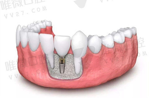 种植牙牙槽骨标准