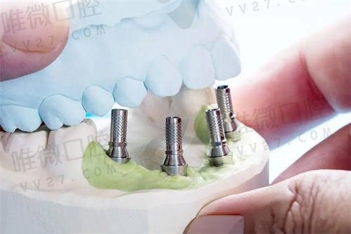 牙齿缺失修复的几种方法