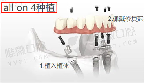 南京美奥口腔医院马院长技术