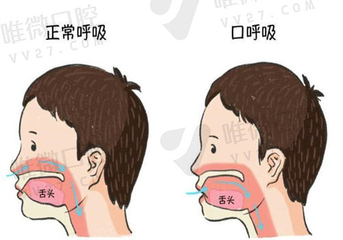 成人口呼吸会导致腺样体面容吗？