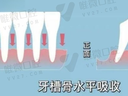 牙槽骨宽度不够想要种植牙怎么办？