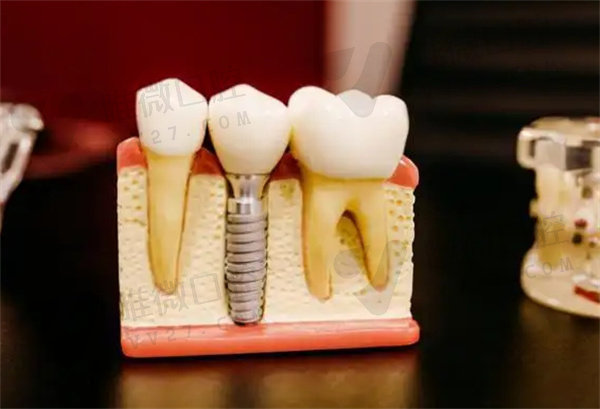 德国朗斯种植牙是几级钛
