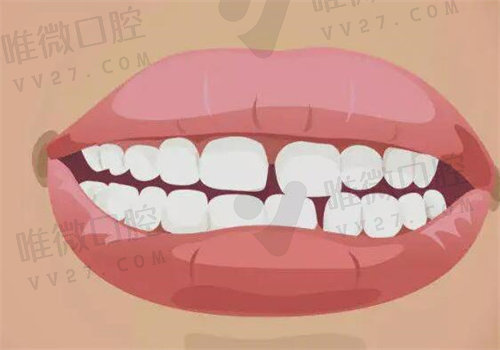 牙齿缝隙越来越大怎么解决？