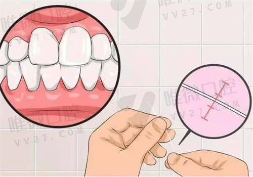 牙齿缝隙越来越大治疗需要多少钱？