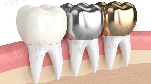 镶牙什么材质的好经济又实惠?