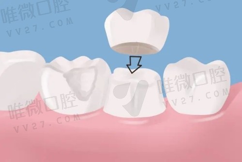 牙冠和贴面哪个伤害大？