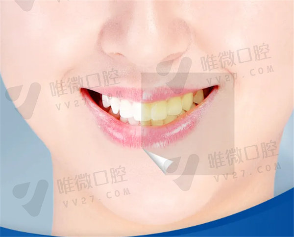超声波洗牙对牙齿有害吗