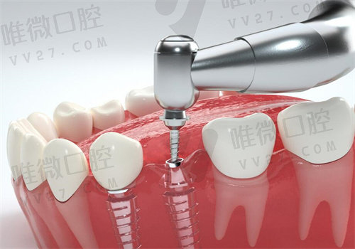 微创即刻种植牙手术过程介绍之术中