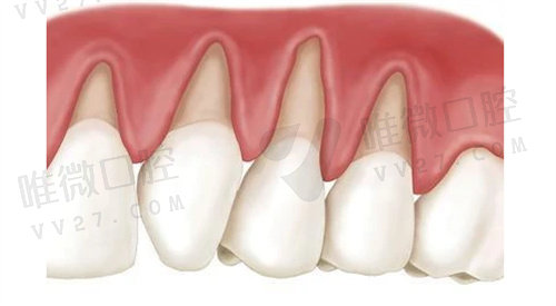 种植牙有8个后遗症