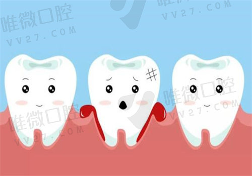 牙龈再生术的弊端