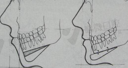 正颌手术在线咨询免费