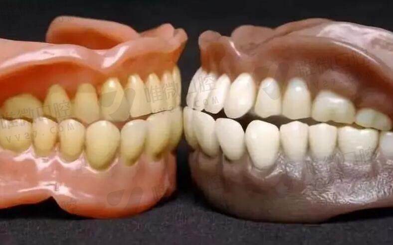 安装假牙的优点和缺点